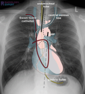 Promixol R Right Heart Cath – PocketRounds