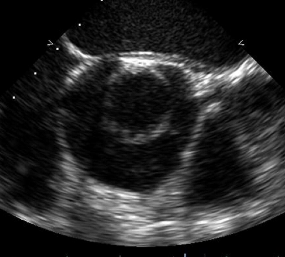 Unicuspid aortic valve morphology