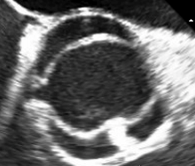Bicuspid aortic valve morphology