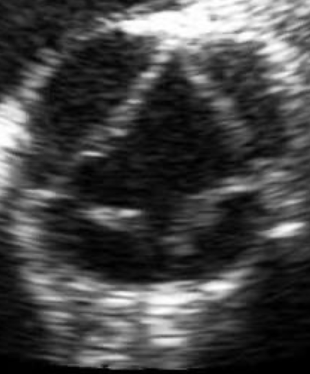 Quadricuspid aortic valve morphology